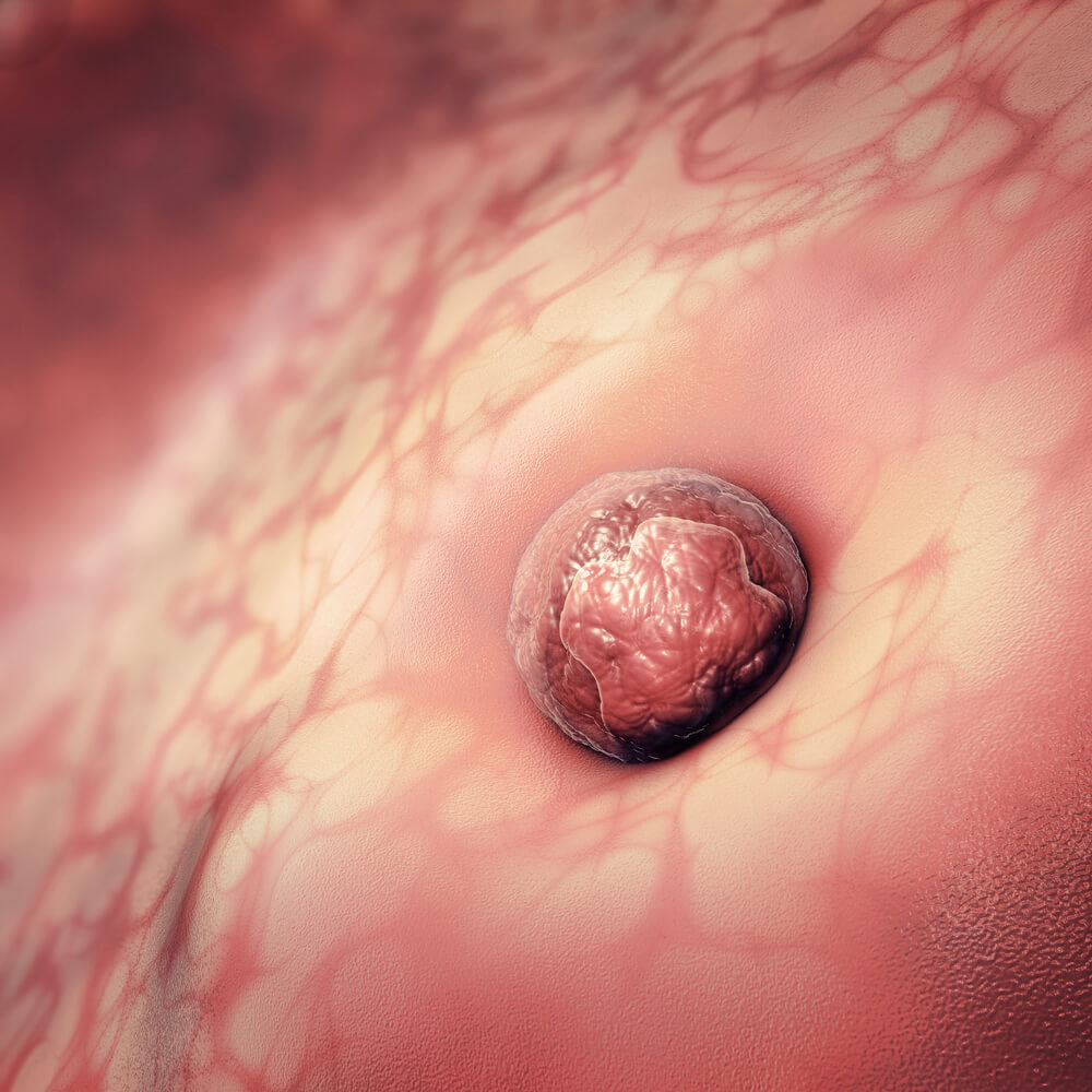 implantación del óvulo en el útero